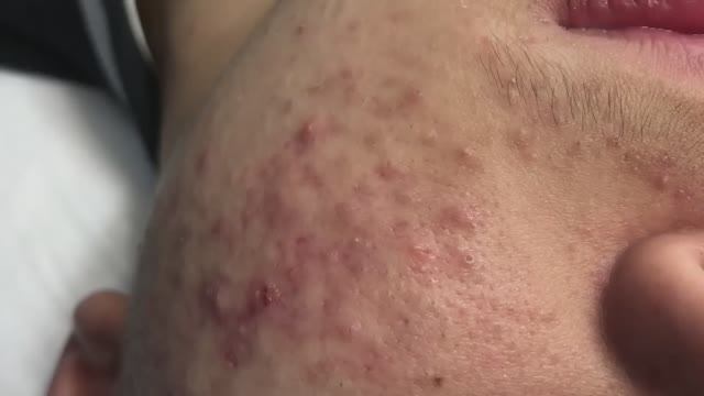 Преображение кожи: удаление акне за одну процедуру