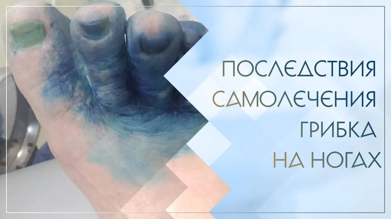 👣 Последствия самолечения грибка на ногах. Клинический случай №40 смотреть онлайн