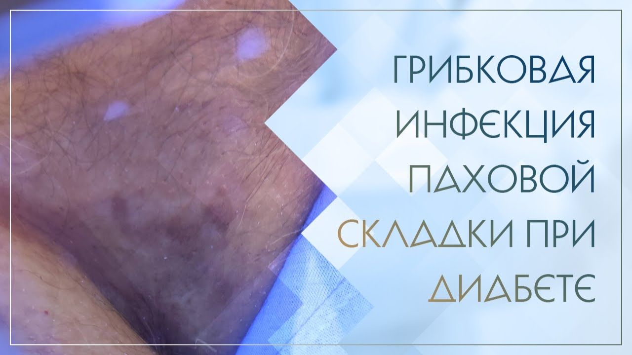 🙁 Грибковая инфекция паховой складки при диабете. Клинический случай №65 смотреть онлайн