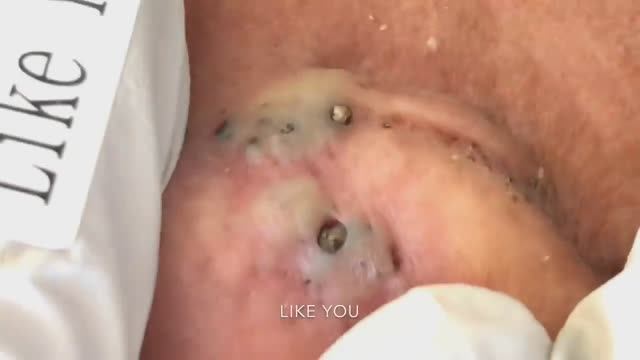 Расслабляющее видео: удаление акне и черных точек за ухом