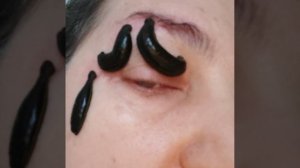 Пиявки на глаз