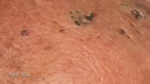 Глубокая чистка лица от черных точек и воспалений