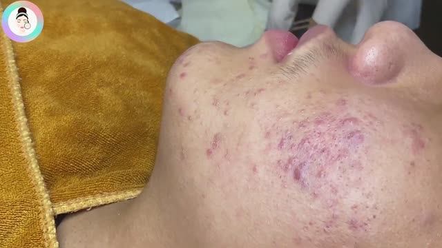 Чистка пор и черных точек. Прыщи на подбородке и по бокам щек