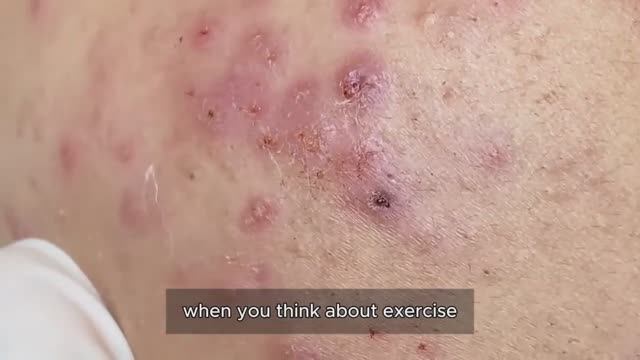 Полное избавление от комедонов на лице. 90344