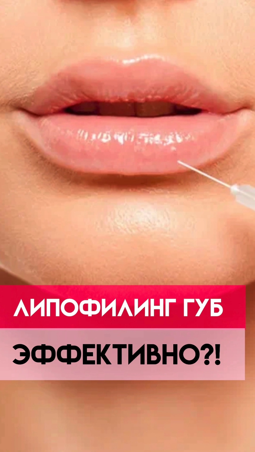 Эффективен ли ЛИПОФИЛИНГ губ на самом деле? смотреть онлайн