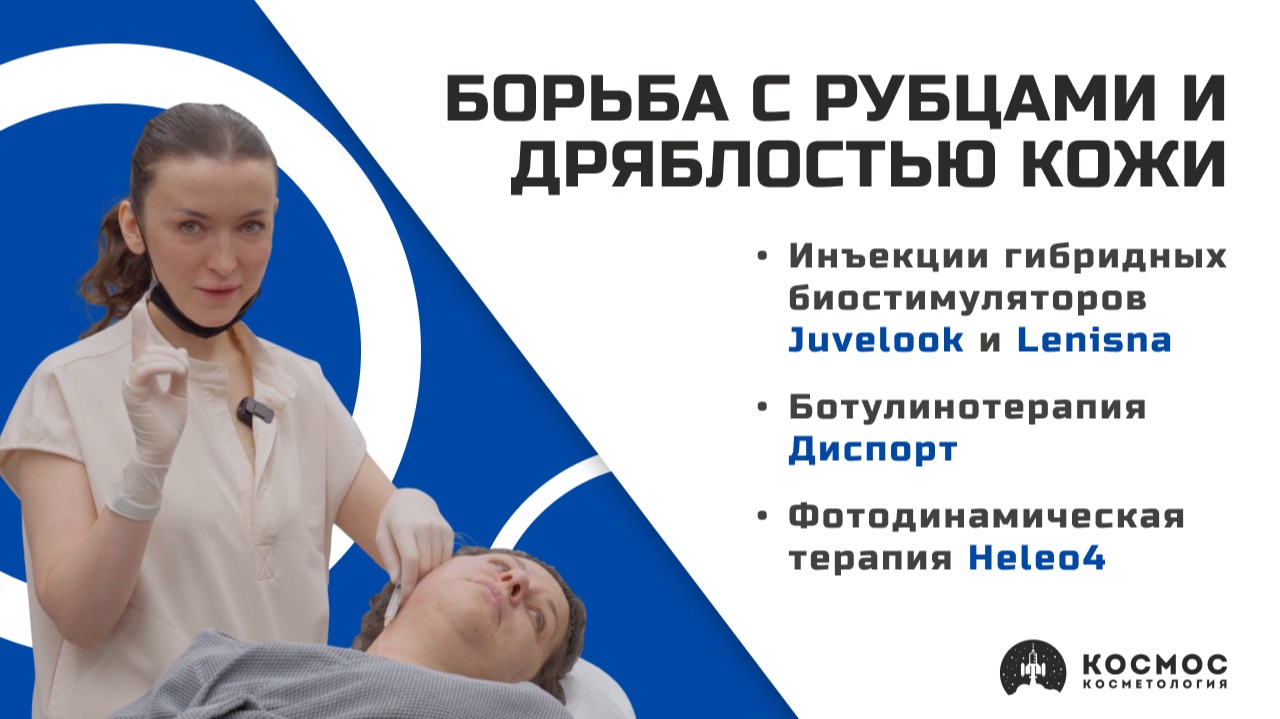 Рубцы постакне и дряблость кожи: комплексное омоложение с полимолочкой ботулинотерапией и Heleo4