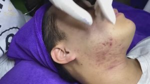 Подкожные прыщи и белые угри: самая неприятная проблема (154)