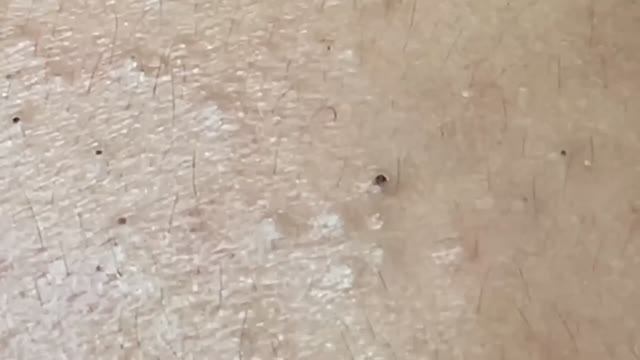 Избавляемся от черных точек. #2181 #чисткалица #проблемнаякожа