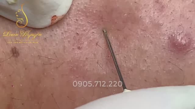 Глубокое очищение: удаляем скрытые прыщи и белые угри #27