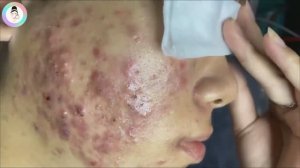 Выдавливание комедонов и воспаленных прыщей