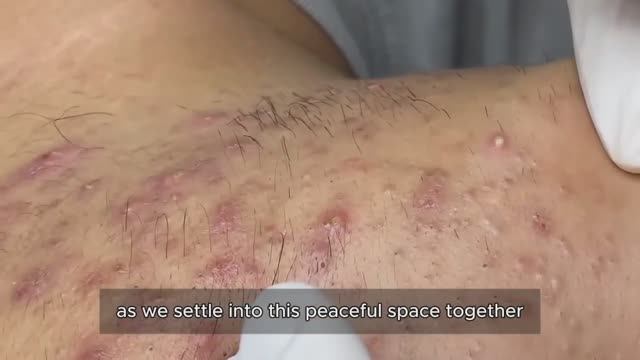 Лечим прыщи, комедоны и сальные пробки. #10015202