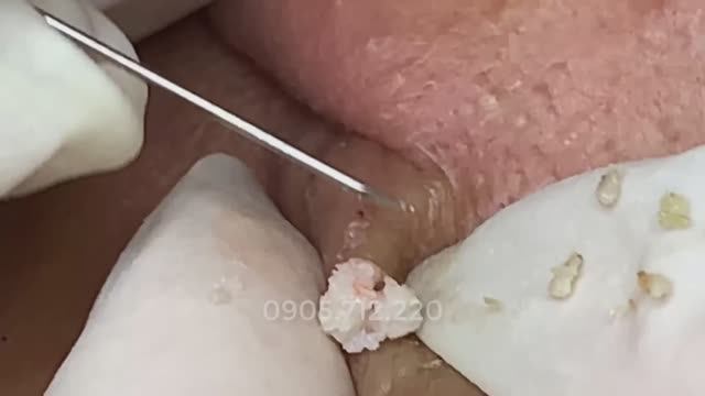 Большая киста и черные точки: чистка у мужчины #26