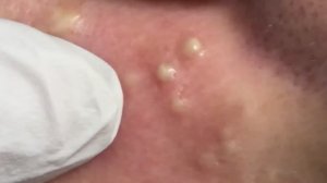 Полное удаление акне: чистка лица у специалиста