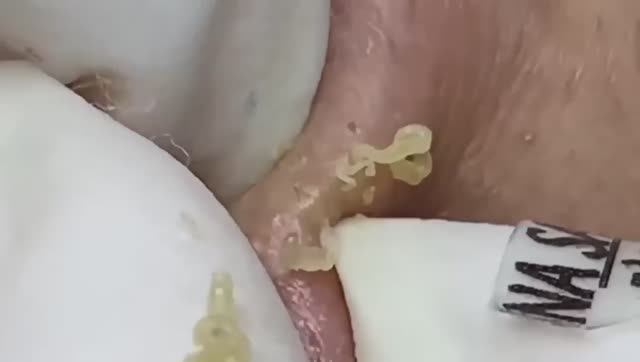 Лечение подкожных угрей. Asmr 2164