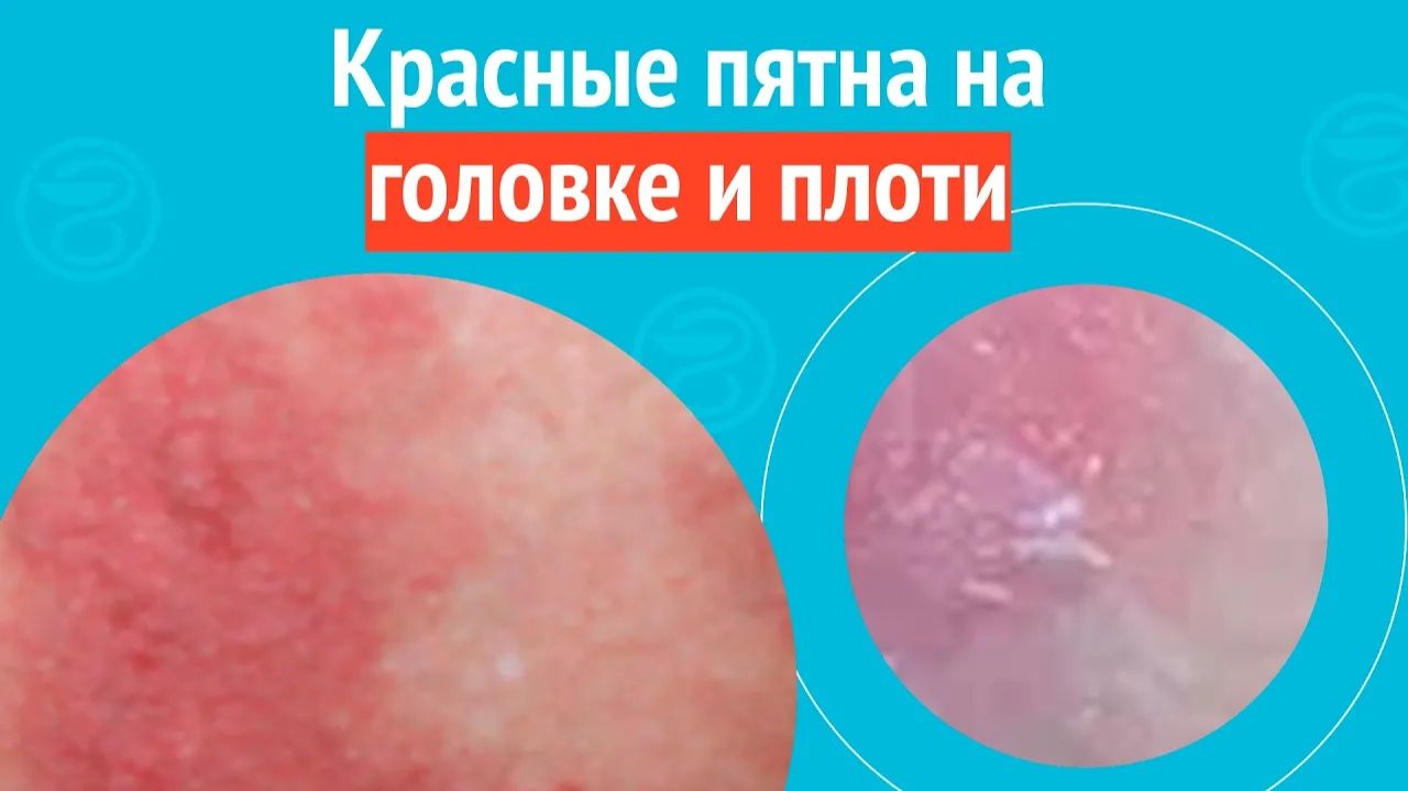 😢 Красные пятна на головке и плоти. Клинический случай № 1730 смотреть онлайн