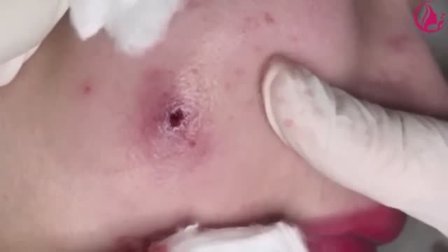 Выдавление огромных прыщей в спа-салоне