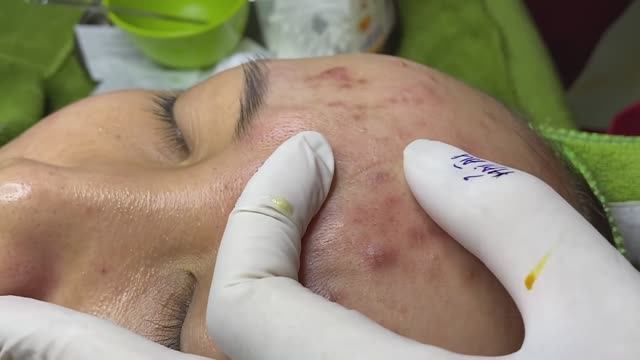 Лечение инфицированных акне #акне #постакне #механическаячистка смотреть онлайн