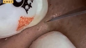 Очищение кожи от черных точек. 2168 #черныеточки #чисткалица  #прыщи #угри