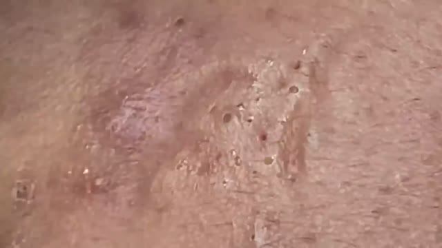 Профессионально чистим кожу от прыщей #2161