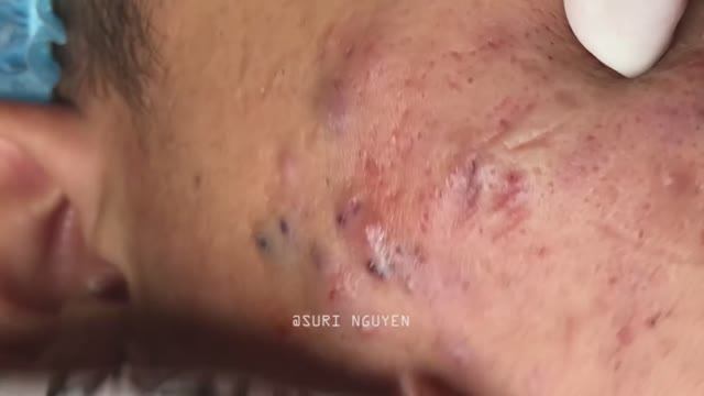 Стойкие высыпания, требующие лечения смотреть онлайн