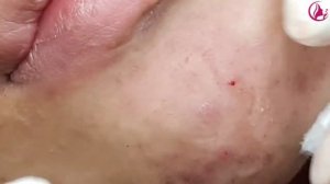 Лечение подкожных прыщей и воспаленных угрей (Часть 2)