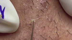 Механическое очищение от черных точек. #132 Asmr