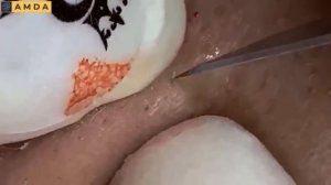 Чистка кожи от комедонов и угрей. Asmr 2180