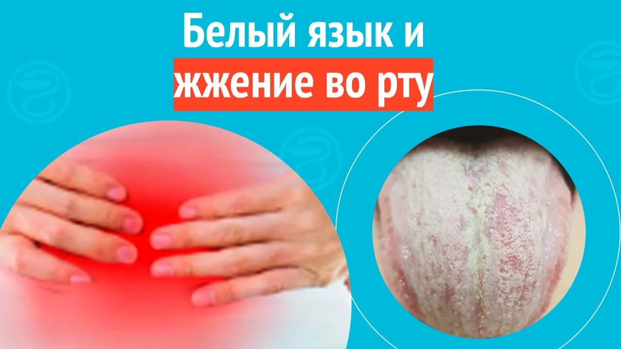 👅 Белый язык и жжение во рту. Клинический случай № 1729 смотреть онлайн