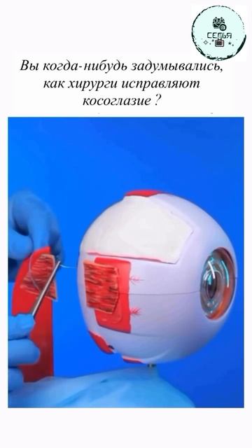 КАК ПРОИСХОДИТ ОПЕРАЦИЯ НА КОСОГЛАЗИЕ