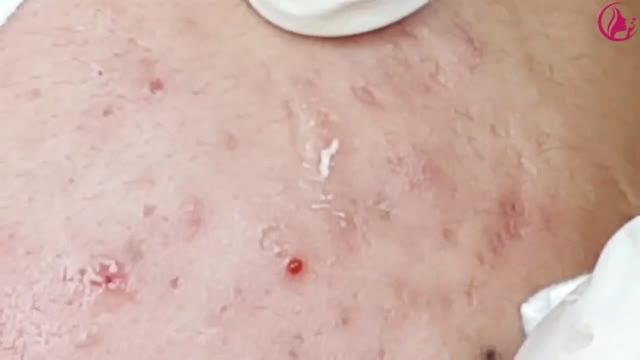 Лечение подкожных прыщей и воспаленных угрей (Часть 1) смотреть онлайн