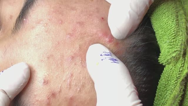 Лечение подкожных прыщей (милиумов) в спа-салоне