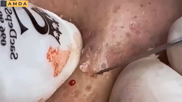 Чистим лицо от комедонов и угрей. Asmr 2174