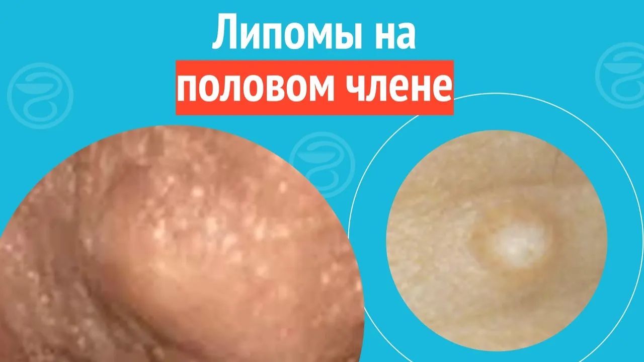 👉 Липомы на половом члене. Клинический случай № 1716 смотреть онлайн
