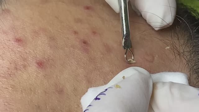 Акне у подростка в 15 лет. Лечение