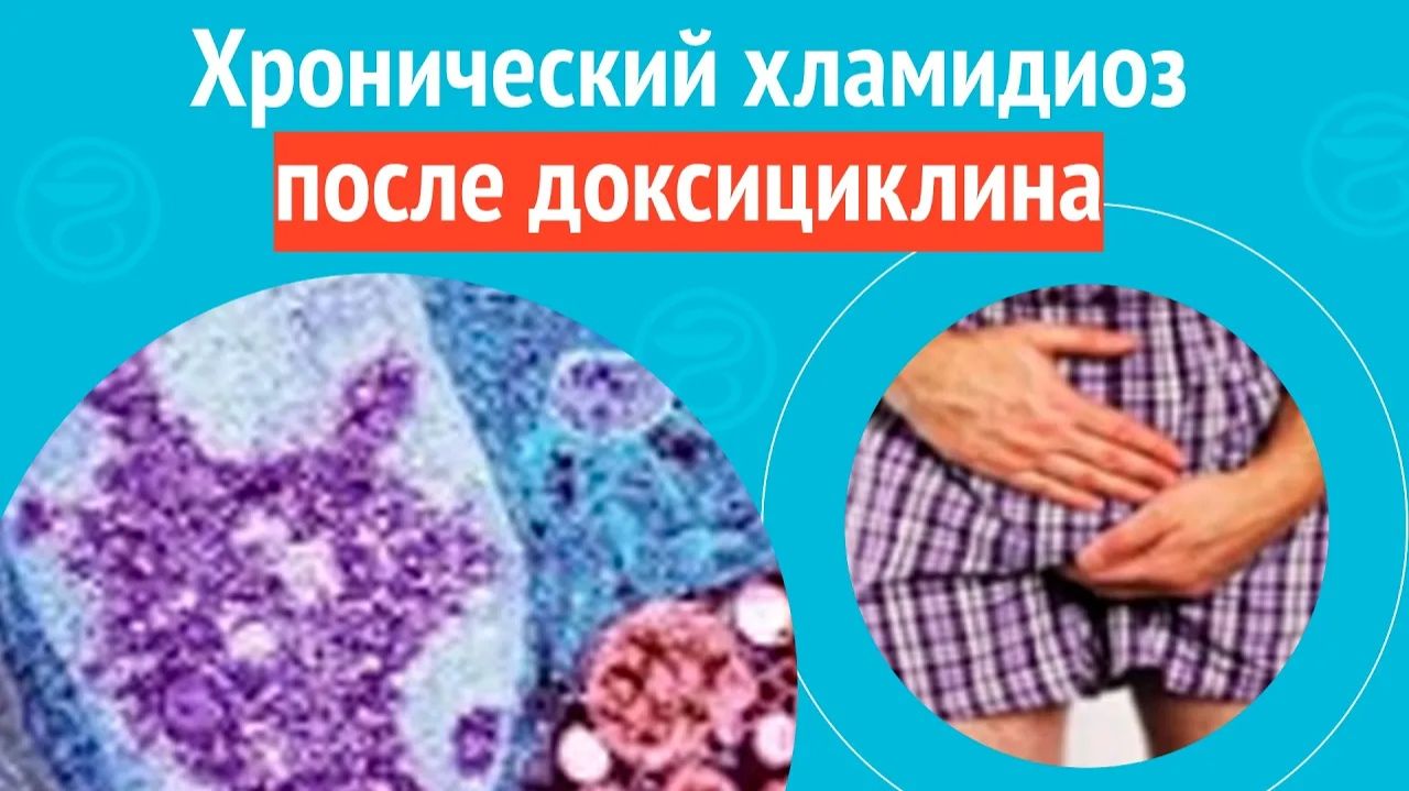 🙄 Хронический хламидиоз после доксициклина. Клинический случай № 1728 смотреть онлайн