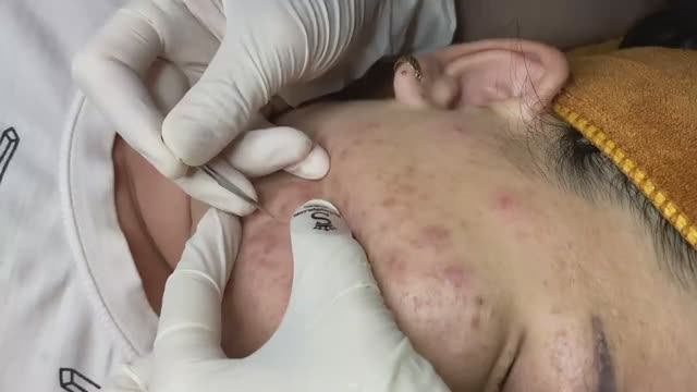 Очень привлекательные прыщи за 35 минут - SDS#125