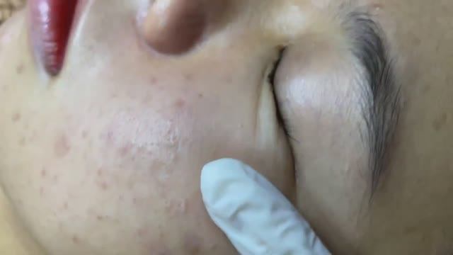 Правильное удаление подкожных прыщей - SDS#122