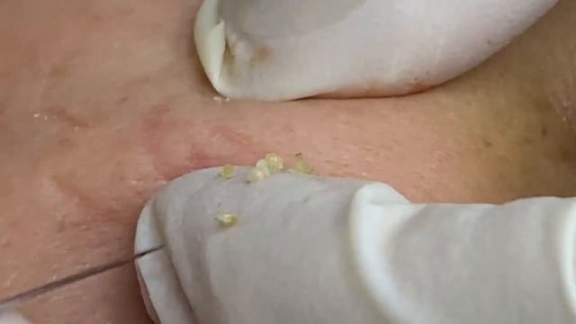 Удаление черных точек без рубцов - SDS#128