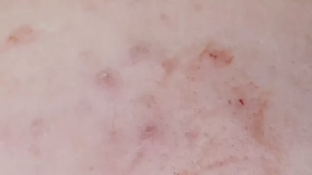 Удаление подкожных прыщей у девушки - SDS#124