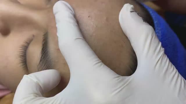 Прыщи под кожей у линии роста волос и в порах - SDS#121