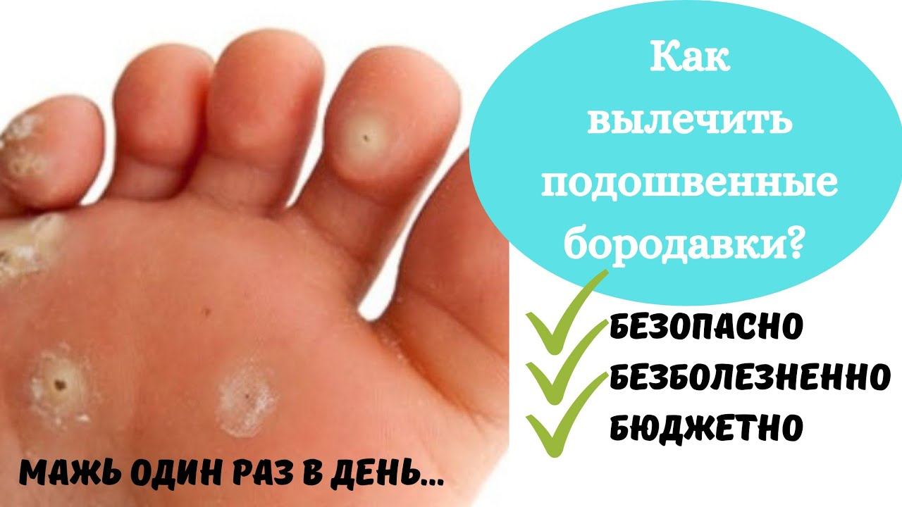 Как вылечить бородавки! Вылечить шипицы. Мой опыт избавления от подошвенных бородавок. смотреть онлайн
