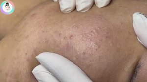 Выдавливание черных точек и открытых комедонов, приятно смотреть #выдавливаниепрыщей #черныеточки