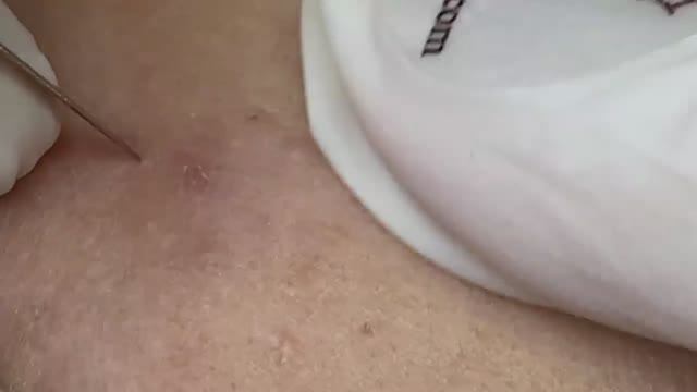 Эффективный метод чистки пор от черных точек- SDS#123 смотреть онлайн