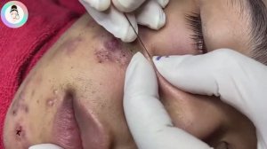 Удаление черных точек, комедонов, воспаленных угрей