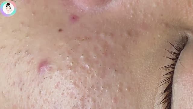 Удаление комедонов и глубоких плотных черных точек смотреть онлайн