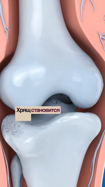 Почему утром суставы «деревянные» и плохо двигаются смотреть онлайн