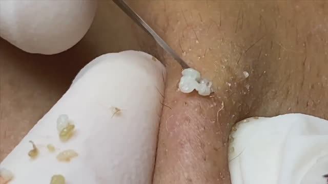 Лучшие случаи акне за месяц Часть 2 - SDS#118