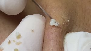 Лучшие случаи акне за месяц Часть 2 - SDS#118