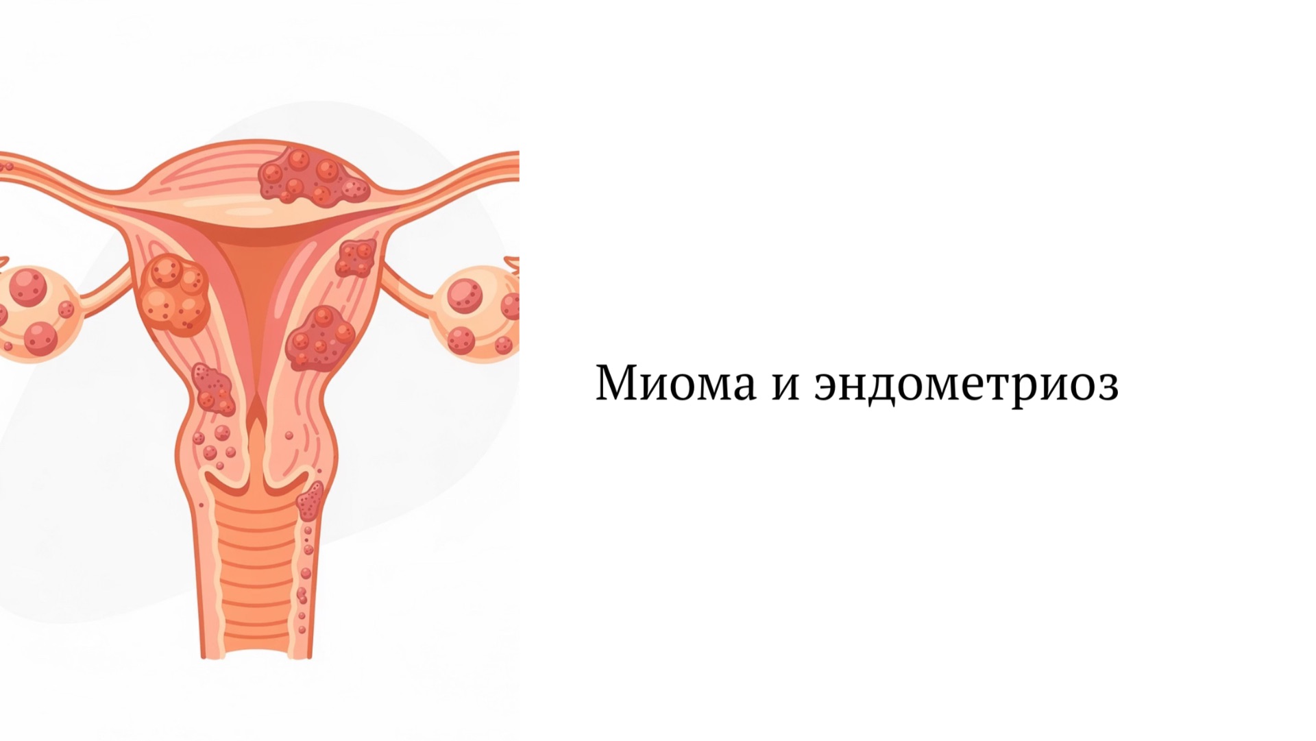Вебинар миомы и эндометриоз смотреть онлайн