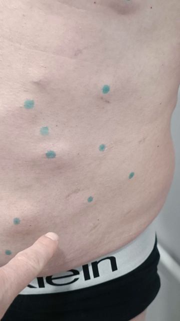 Липоматоз - множественные липомы